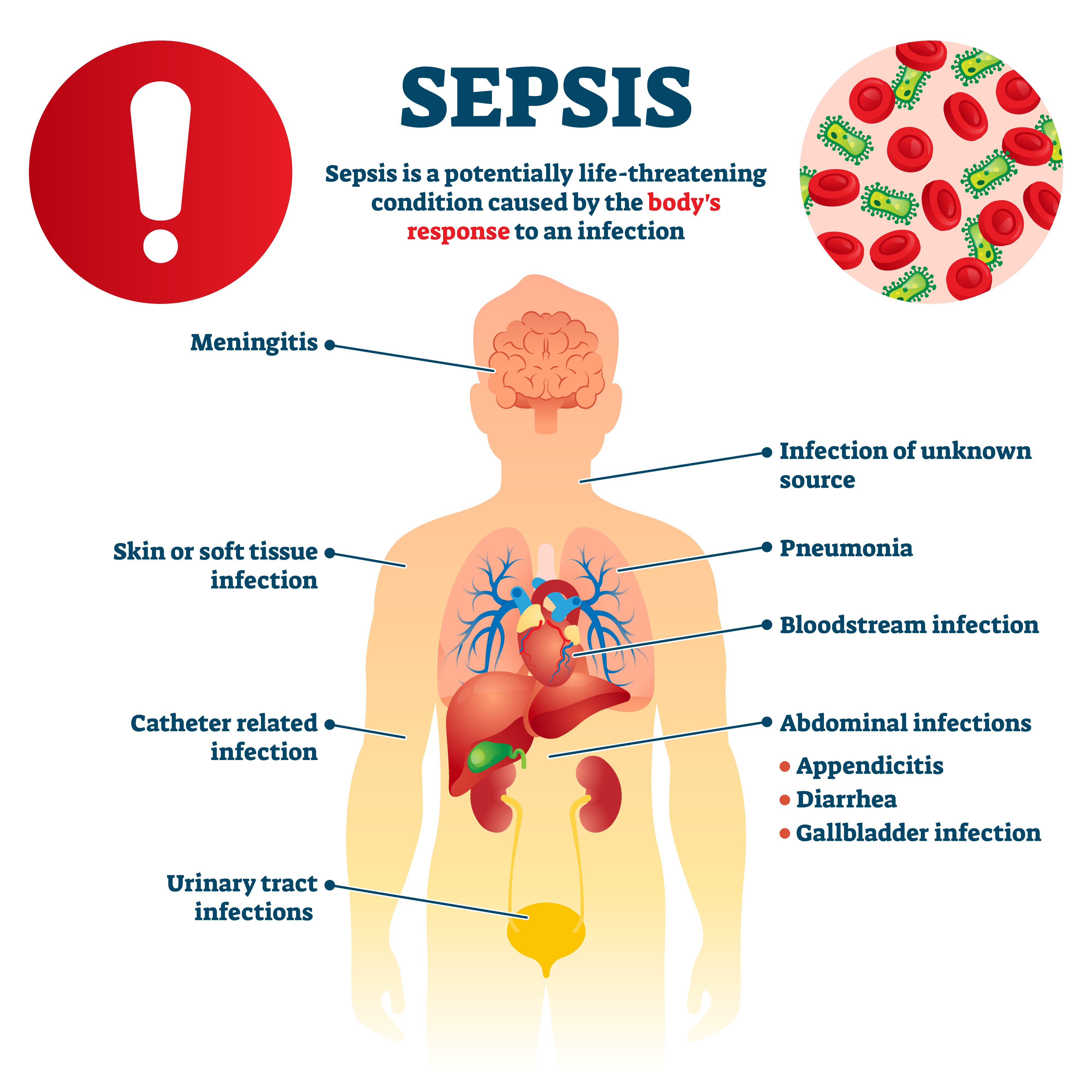 Sepsis vector illustration. Labeled infection condition educational scheme. Diagram with anatomical health symptoms and causes explanation. Body's response to bacteria illness and disease collection.